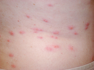 Bedbug Bites