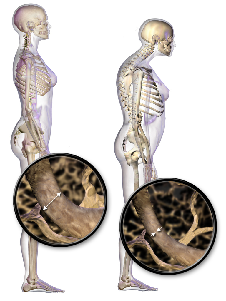 Skeleton-Osteoporosis